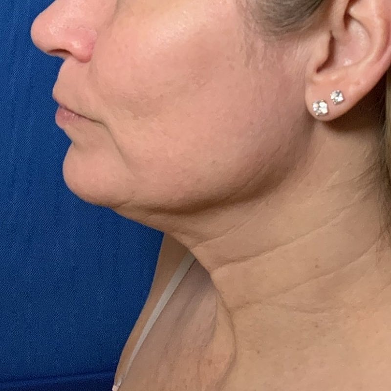 Morpheus8 Before & After